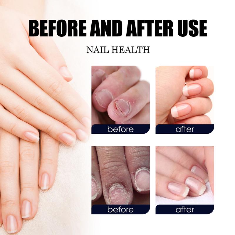 PLANT DROPS tea Tree Oregono oil nail support unisex obvious effect Nail Care 10ml 0.34 FI.oz。Nail Care Plant Drops Nail Growth Serum Moisturize Repair