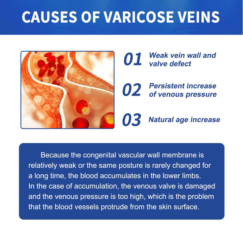 South Moon Vein Massage Varicose Cream Repair earthworm legs to relieve leg blood vessel bulge and varicoidea