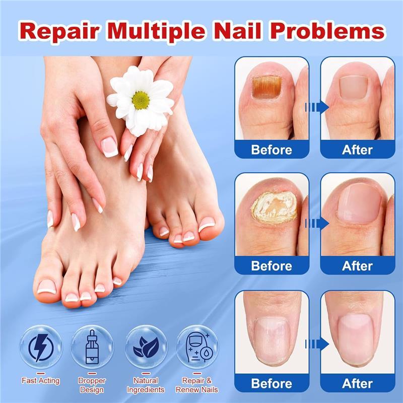 Toenail Fungus Treatment, Extra Strength Nail Toenail Fungus Remover, Toe Fingernail Repair Liquid Solution Fast Acting for Woman and Man - 30mL(1 fl oz)