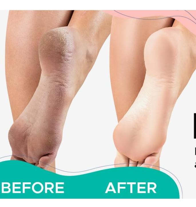 Professional Best Callus Remover Gel for Feet and Foot Pumice Stone Scrubber Kit Remove Hard Skins Heels and Tough Callouses from feet Quickly and Effortless 4 oz (1 Bottle)