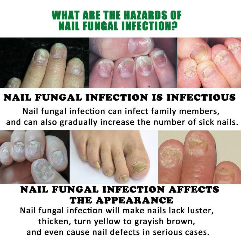 JAYSUING Ginger Nail Treatment|Vitamin E & Plant Essential Oils for Nail Care| Supports Recovery from Onychomycosis, Paronychia, & Nail Deformation | Comforting Manicure & Nail Art Solution Ginger Nail Nourishing Smooth