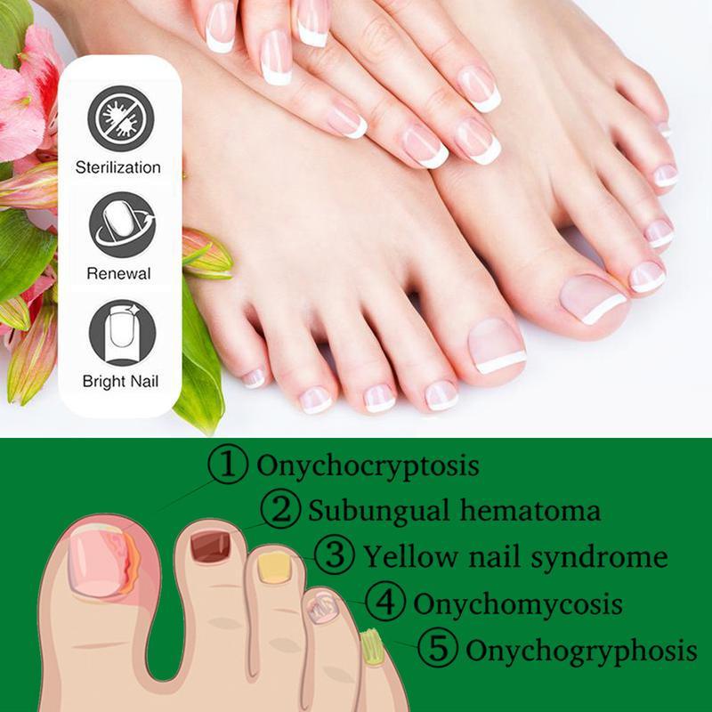 JAYSUING Ginger Nail Treatment|Vitamin E & Plant Essential Oils for Nail Care| Supports Recovery from Onychomycosis, Paronychia, & Nail Deformation | Comforting Manicure & Nail Art Solution Ginger Nail Nourishing Smooth