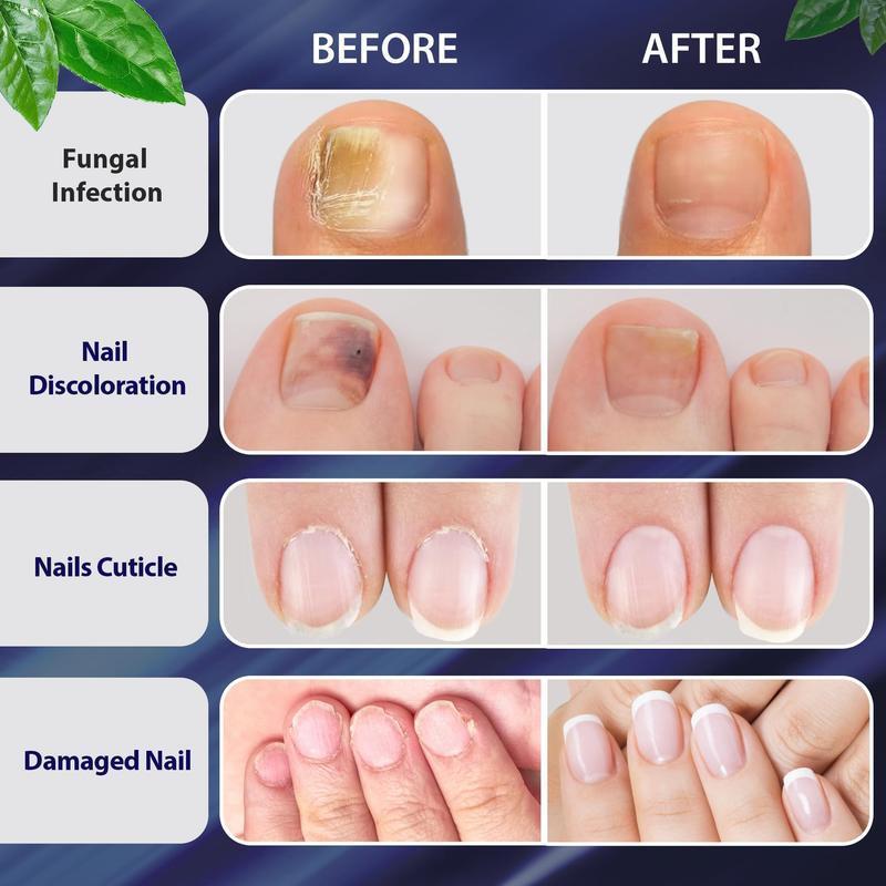 Tea Tree + Oregano Oil Nail Support for Healthy Nails - Nail Care Nail Polish Nail Art